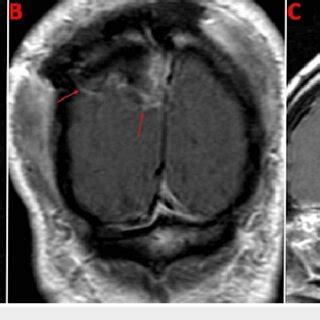 Postoperative Mri Brain Post Contrast In The Axial A Coronal B