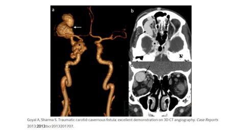 Carotid Cavernous Fistulas Ppt