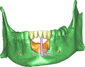 Singapore dental implant case study: distraction osteogenesis