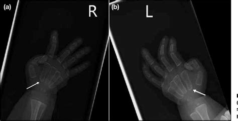 Figure From Mucolipidosis Type Ii I Cell Disease A Rare Condition