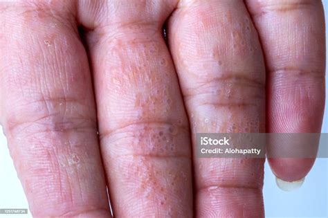 Close Up Atopic Dermatitis On Finger Also Known As Atopic Eczemaskin