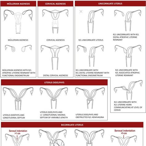 The Classification Of Mullerian Anomalies By American Society Of