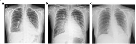 Pleural Effusion Radiograph