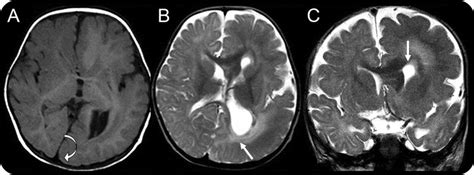 Teaching Neuroimages Hemimegalencephaly In Linear Nevus Sebaceous