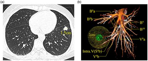 Preoperative Threedimensional Computed Tomography Bronchography And