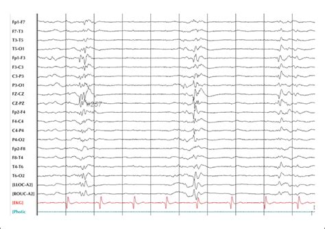 JLE Epileptic Disorders A Comparison Of Continuous Video EEG