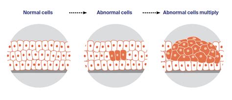 Lung Cancer Cells Vs Normal Cells