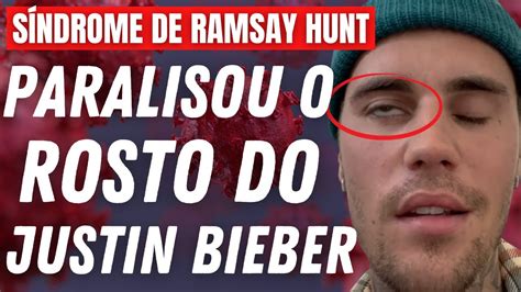 S Ndrome De Ramsay Hunt Tudo Sobre A Doen A Do Justin Bieber Dr