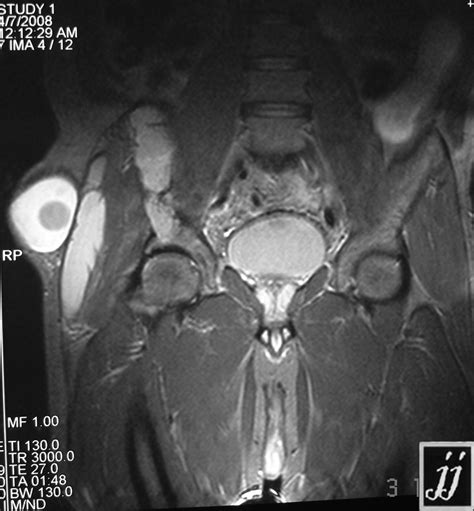 Right Gluteal Region Abscess Radiopaedia