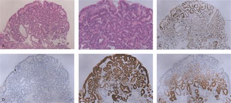 Pathological Images Showing Pga With Low Grade Intraepithelial