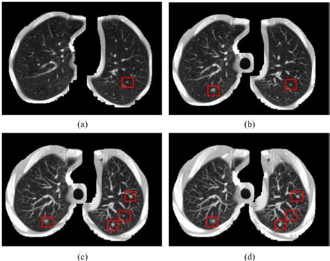 Figure From Automatic Pulmonary Nodule Detection In Ct Scans Using