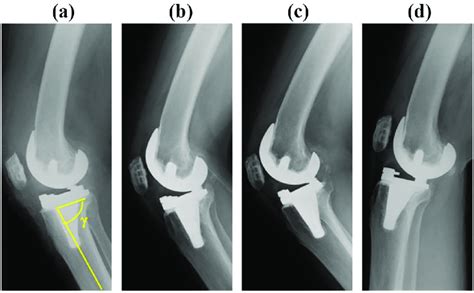 Post Operative Anteroposterior And Lateral Plain Radiographs The γ