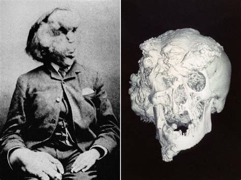 The Heartbreaking Story Of Joseph Merrick The Elephant Man Who Sought