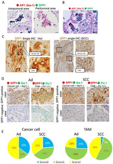 Cancers Free Full Text Spp Derived From Macrophages Is Associated