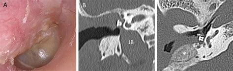 Cholesteatoma Surgery With A Dehiscent High Jugular Bulb Treated With