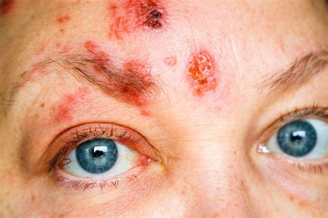 Shingles On The Face Symptoms Treatment And More