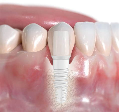 Three Reasons To Choose Dental Implants Over Dentures Havrilla Center