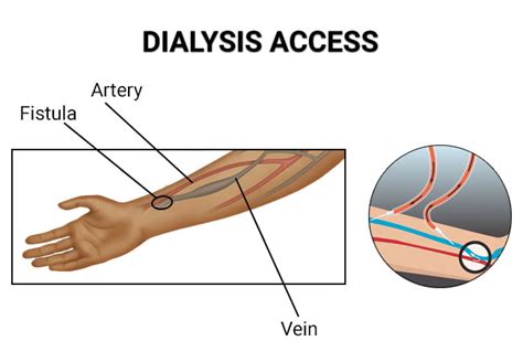 Dialysis Access Management Vein Endovascular Medical Care