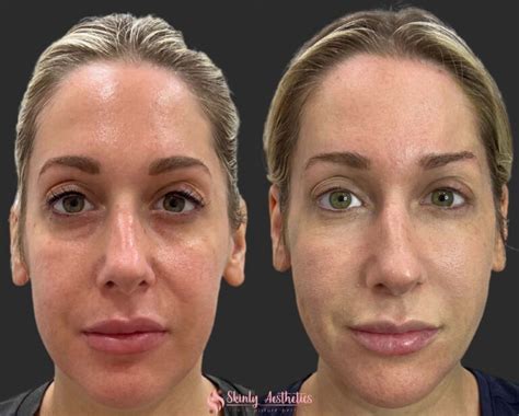 Cheek Filler Augmentation In Nyc With D Schwarzburg Md