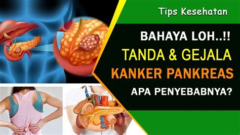 Tanda Dan Gejala Kanker Pankreas Ternyata Penyakit Ini Sangat Berbahaya