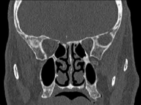 Cranio Facial Ct Scan Coronal Section Areas Of Posttraumatic