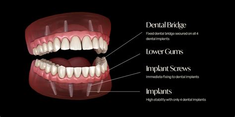 All On Dental Implants Melbourne Dr Jaclyn Wong