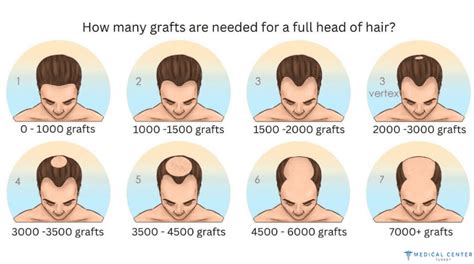 A Guide To Hair Transplant Success Rates Mct