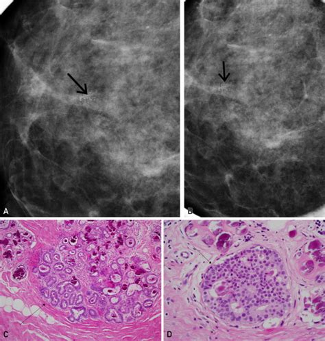 Diagnosis And Management Of Benign Atypical And Indeterminate Breast Lesions Detected On Core