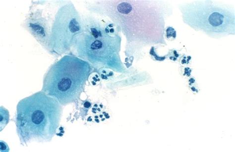 Impression Cytology Smear Stained By Papanicolaou Stain This Specimen Download Scientific