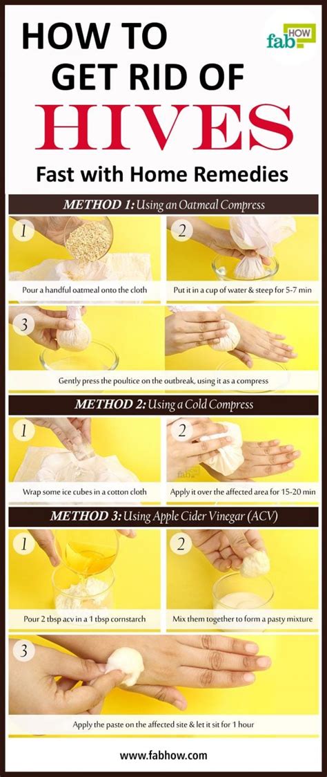 How To Get Rid Of Hives With Home Remedies Fab How