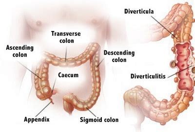 Diverticulitis Symptoms, Treatment, Causes, Medicines