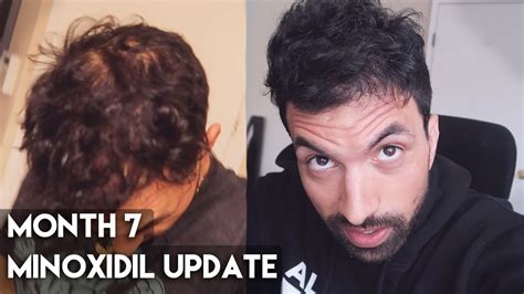 7 Month Rogaine Minoxidil Results Crazy Improvement Youtube