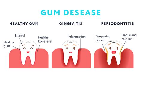 What Is Gingivitis Plotting With Dr Potts