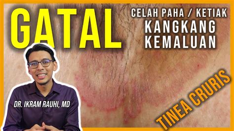 Celah Peha Ubat Gatal Celah Kelangkang Farmasi Ubat Gatal Kudis Kurap