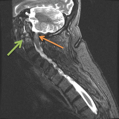 Cervical CT Showing Subluxation Of The Posterior C1 Ring Into The