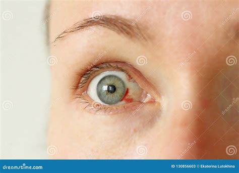 Bloodshot Eye Woman With Burst Blood Vessel In Eye Stock Image Image