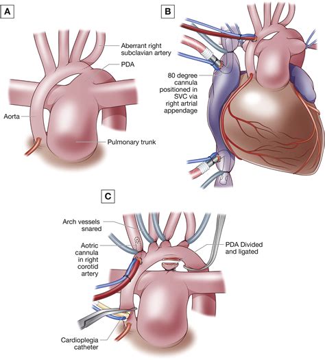 Norwood Procedure Hypoplastisch Linker Hart Syndroom – CAHAL