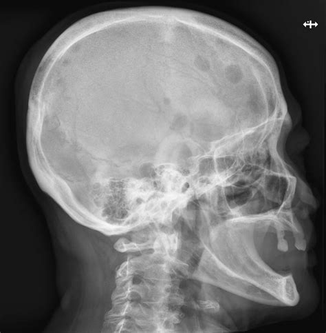 Lytic Lesions In The Skull Radiology Cases