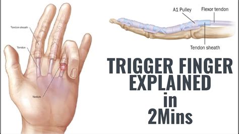 Trigger Finger Explained In 2 Mins YouTube