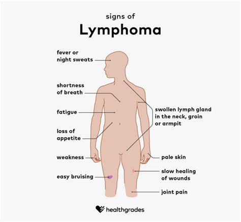 How To Diagnose Lymphoma Contestgold8