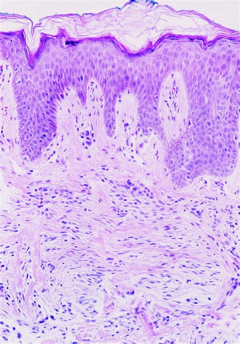 Neurothekeoma Report Of A Case In An Infant And Review Of The Literature Journal Of The