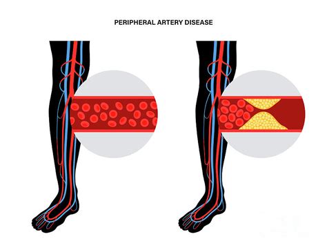 Peripheral Artery Disease Photograph By Pikovit Science Photo Library Pixels