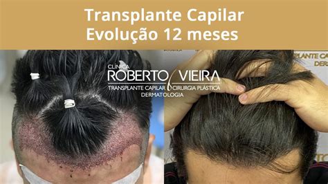 Evolução 12 meses Transplante Capilar FUE YouTube