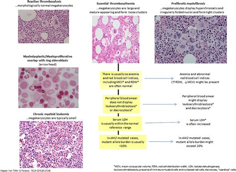 Distinguishing Features Between Essential Thrombocythemia And Other