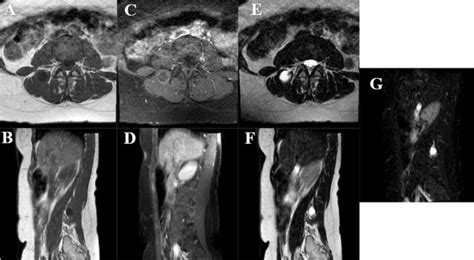 Pre Operative Axial And Sagittal Mri Images Demonstrating A Right Sided