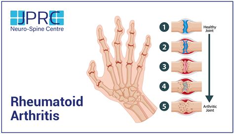 New Treatments For Rheumatoid Arthritis Gaby Pansie