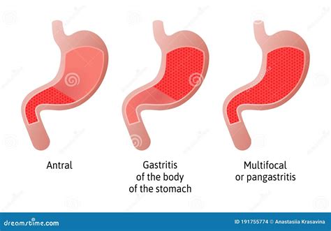 The Types Of Gastritis Vector Illustration CartoonDealer 93431506