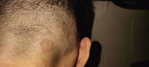 Ringworm Of The Scalp Tinea Capitis Causes Symptoms And Off