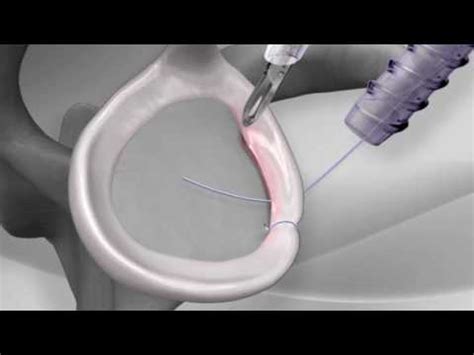 Knotless Shoulder Labral Repair With Arthrex Pushlock Youtube