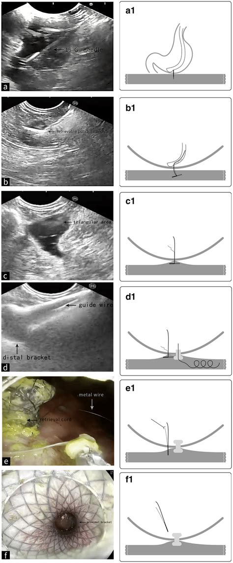 Eus Ge Procedure A Endoscopic Ultrasound Image The Bowel Is Punctured